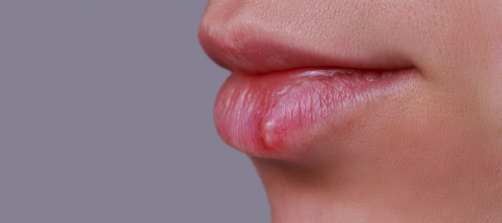 Herpes labial en Malgrat de Mar Herpes labial en Malgrat de Mar